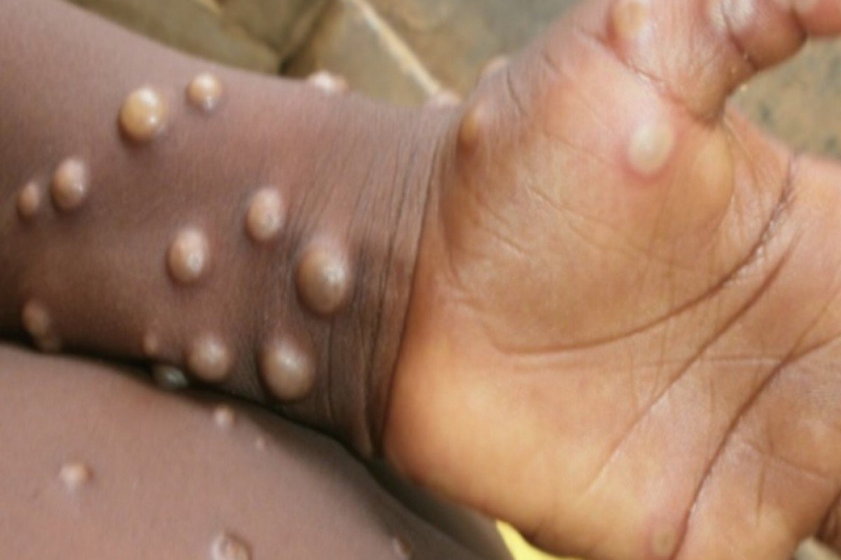 Monkeypox Press Release