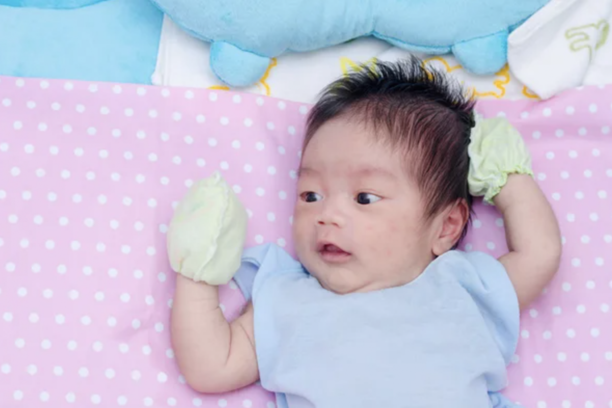 Jerawat Bisa Terjadi Pada Bayi dan Anak
