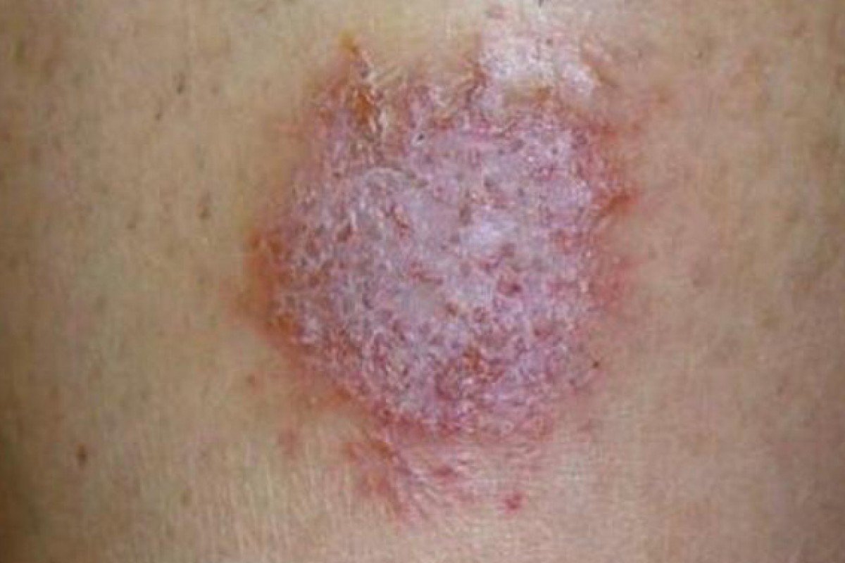 Ketahui Lebih Jauh Tentang Dermatitis Numularis