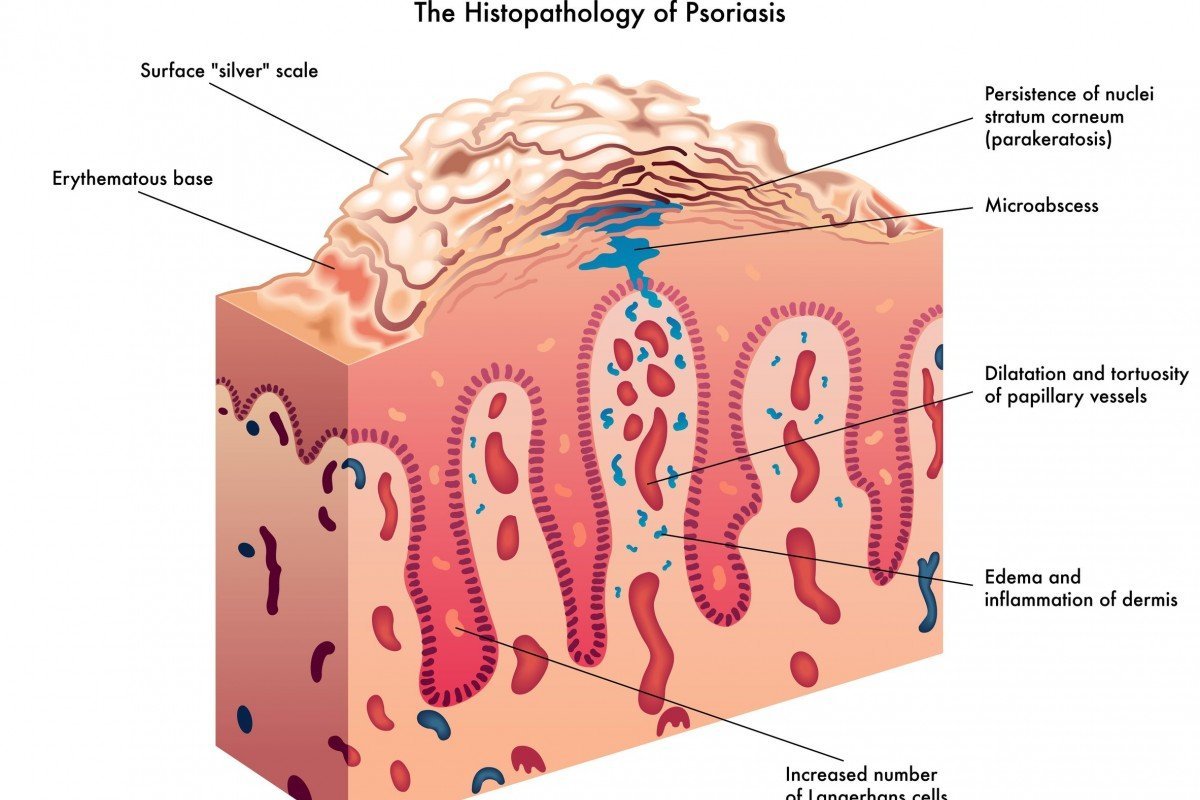 Jangan Heran Kalau Anak-Anak Juga Bisa Menderita Psoriasis