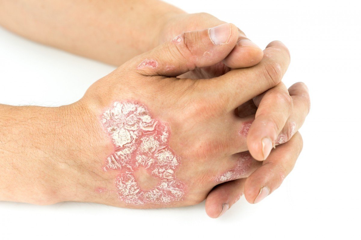 Timbulnya Bercak Kemerahan Disertai Nyeri Sendi Bisa Berarti Psoriatic Arthritis