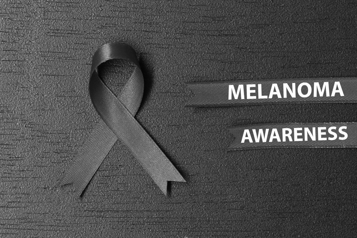 Perhatikan Tahi Lalat Anda! Bisa Jadi Petunjuk Awal Kanker Melanoma