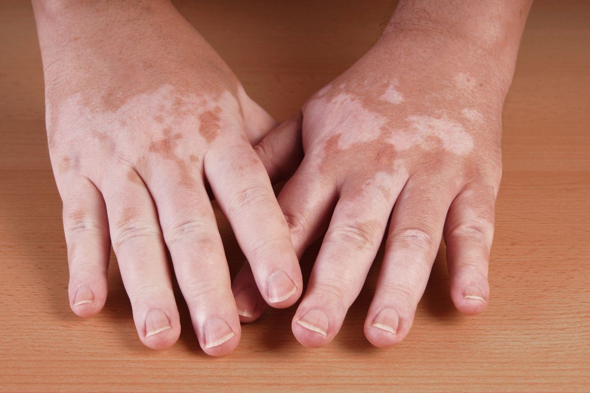 Vitiligo dan Albinisme, Apa Bedanya?      