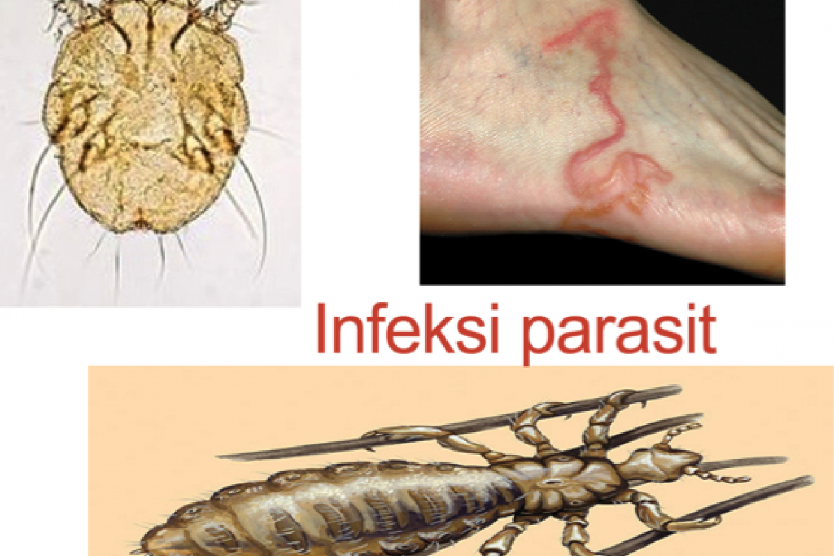 Infeksi Parasit
