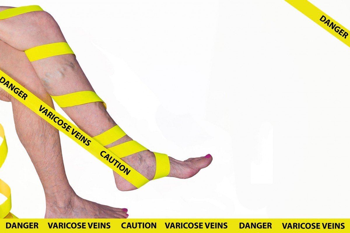 Varises Tidak Hanya Mengganggu Penampilan, Tapi Juga Kesehatan Kaki Anda