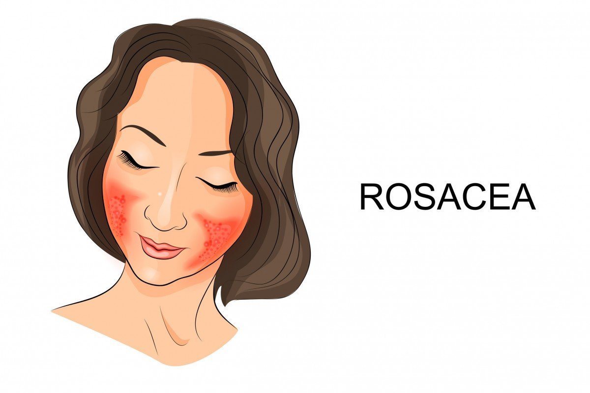 Rosacea: Penyakit Kulit yang Gejalanya Mirip dengan Alergi