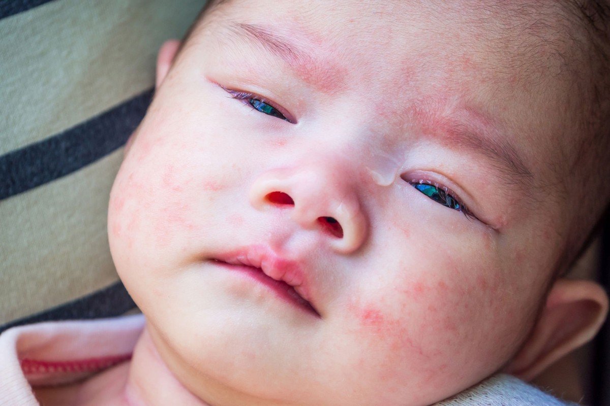 Eksim Atopik, Bisa Membuat Bayi Anda Tidak Tidur Semalaman