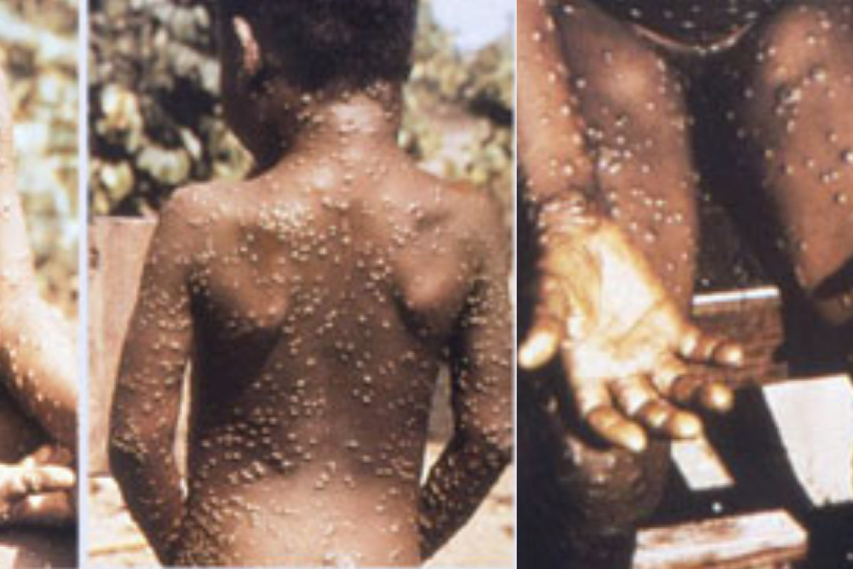 Monkeypox, Ketahui Gejala dan Penanganannya