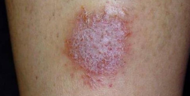 Ketahui Lebih Jauh Tentang Dermatitis Numularis